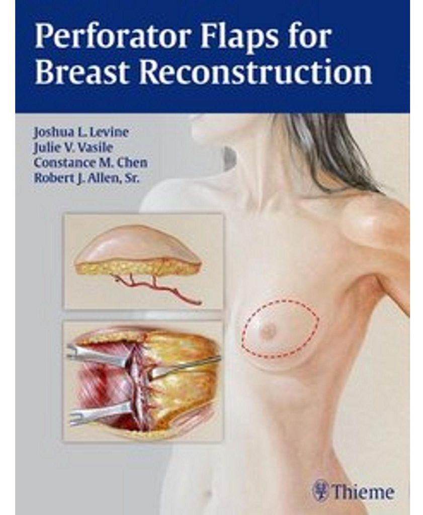 Perforator Flaps for Breast Reconstruction