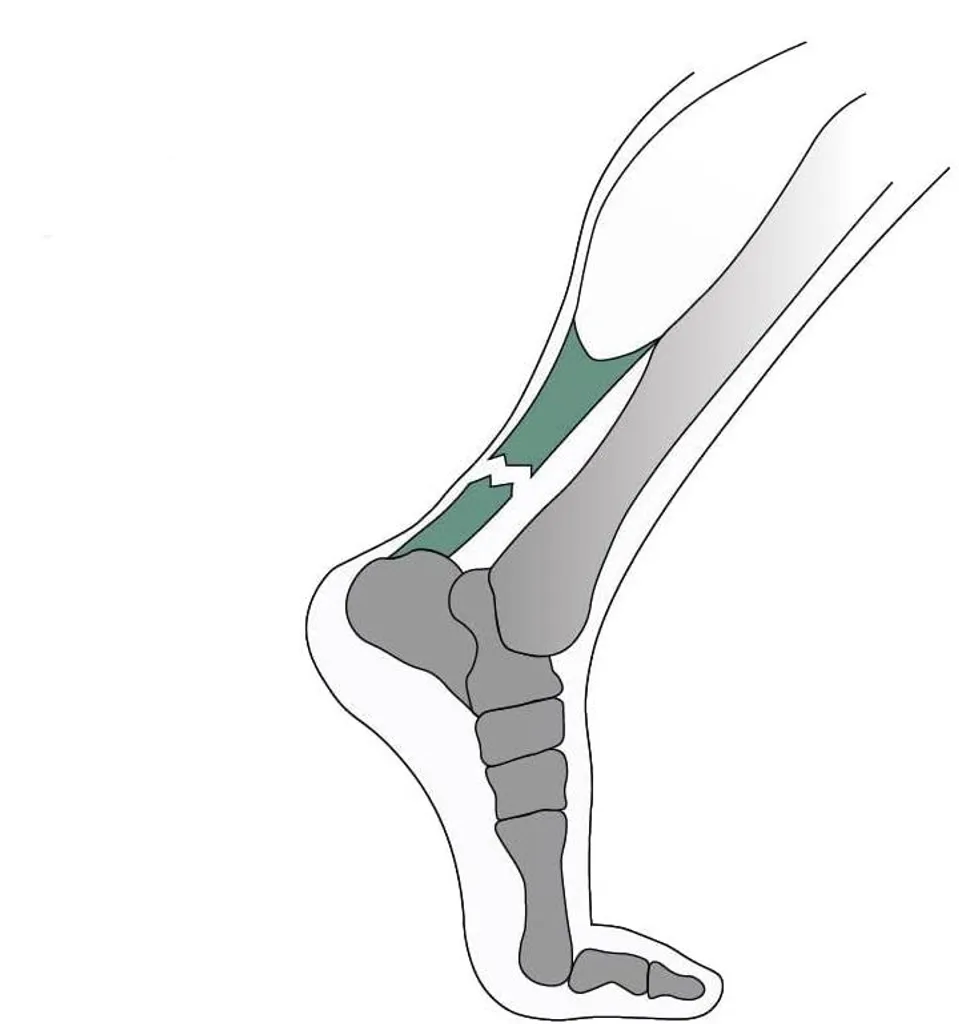 Orthèse de nuit tendon d'Achille rigide pour rupture taille S
