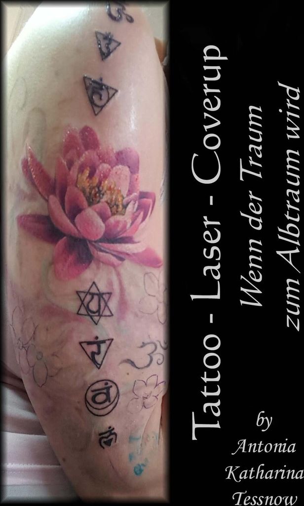 Tattoo - Laser - Cover Up