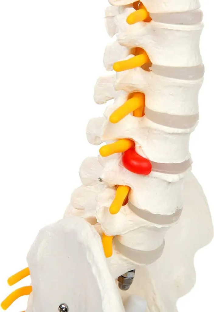 Modèle colonne vertébrale pour expliquer la hernie et sciatique