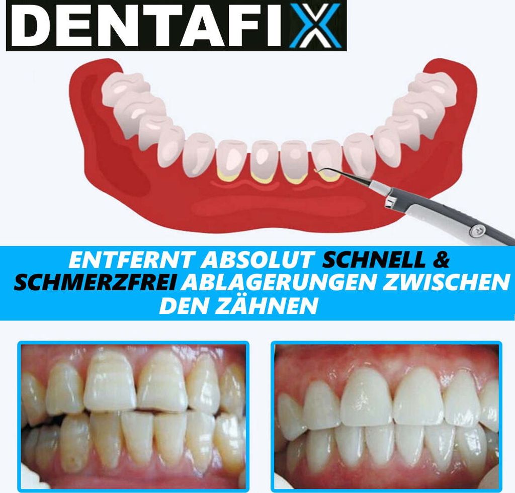 DENTAFIX elektrischer Zahnsteinentferner Zahnpflege Produktbild 4
