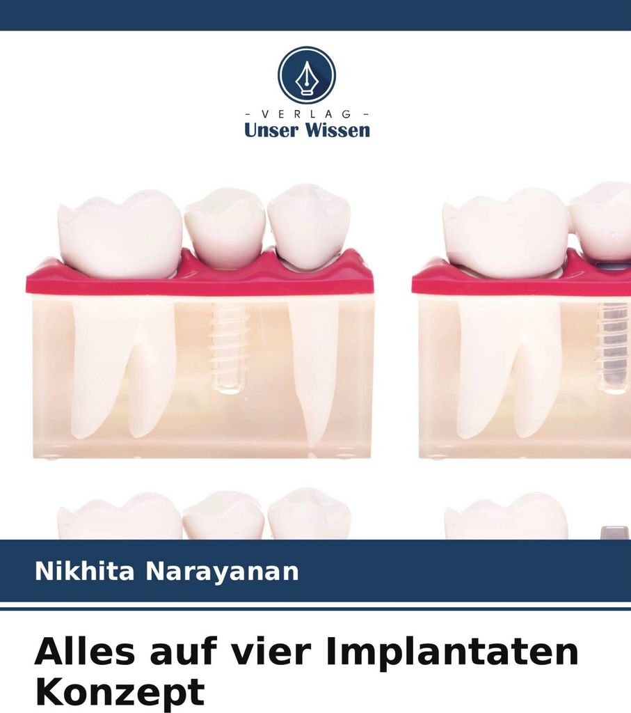 Alles auf vier Implantaten Konzept