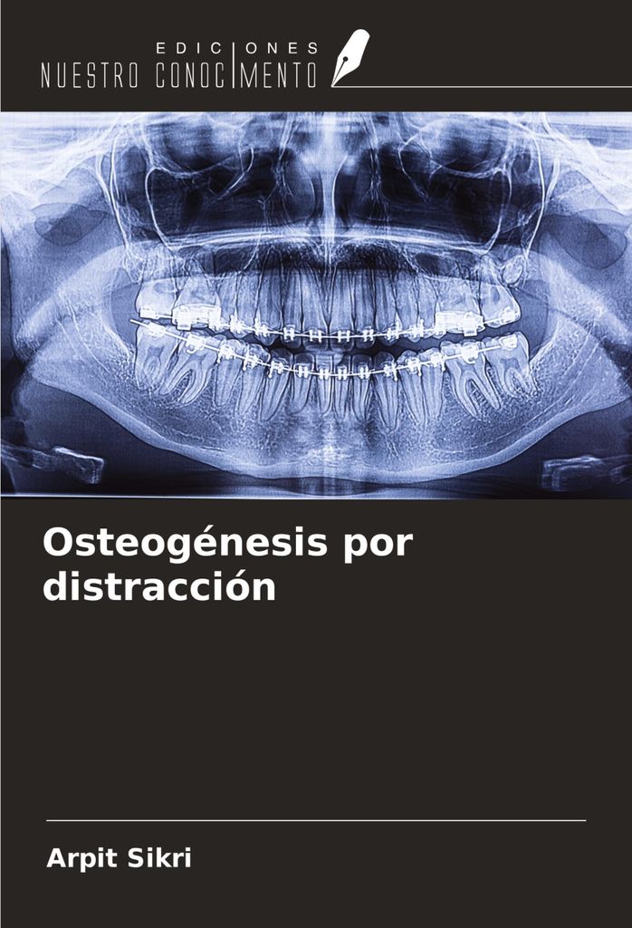Osteogénesis por distracción