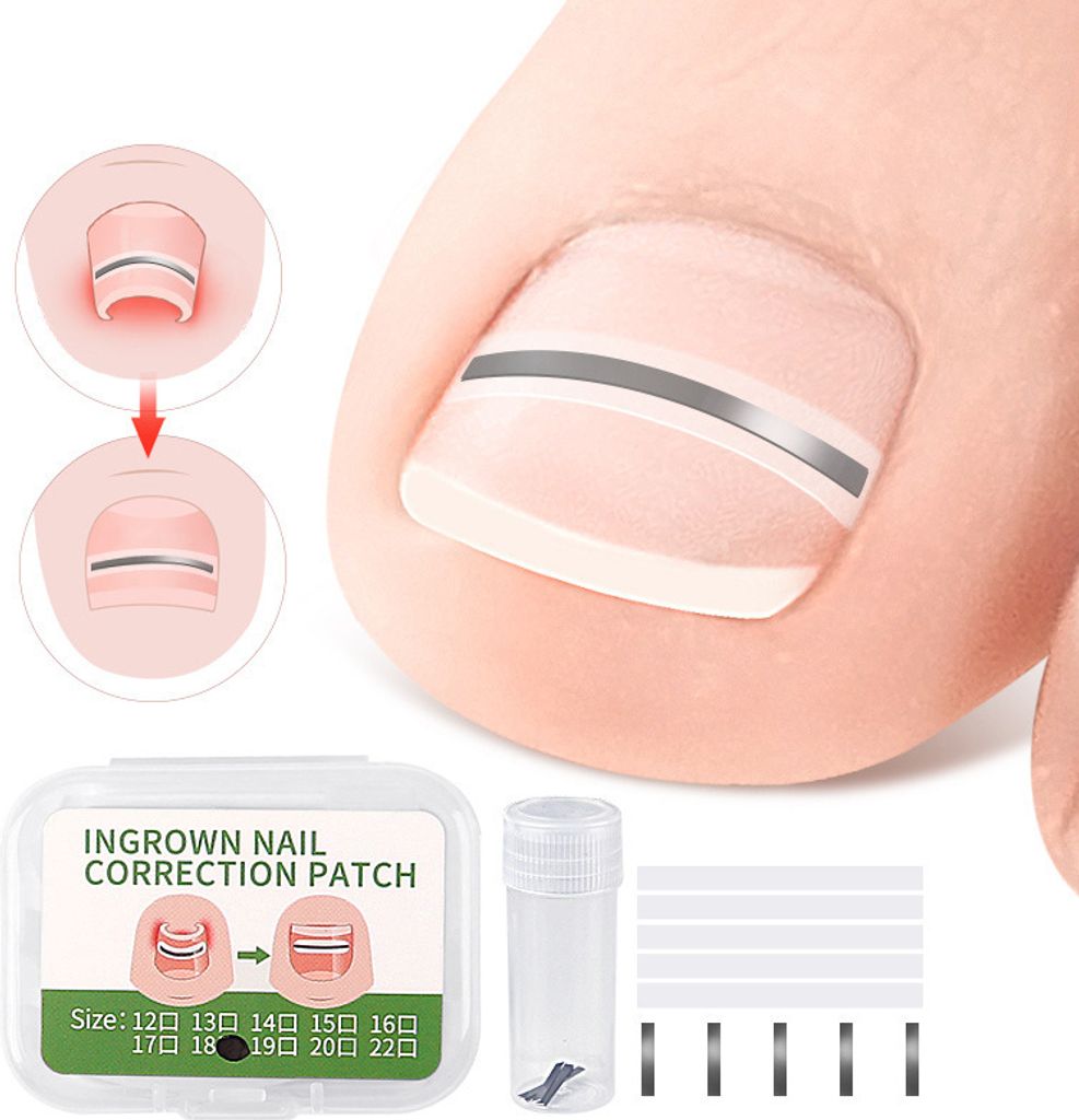 A close-up of a toe with an ingrown nail correction patch applied, along with a package of the patches and a tool.