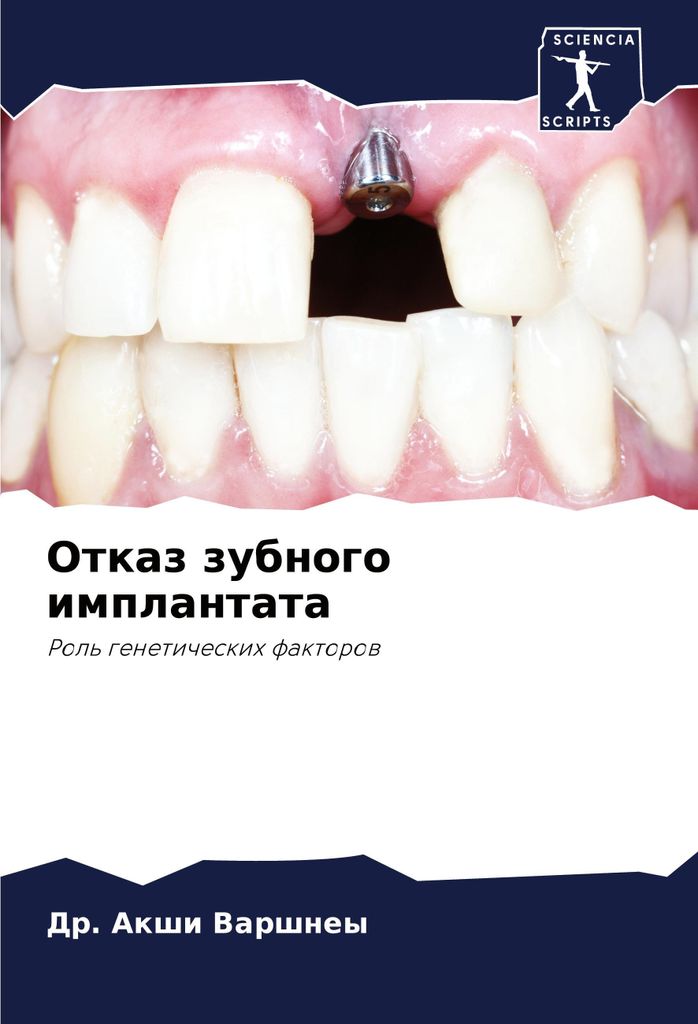 Otkaz zubnogo implantata
