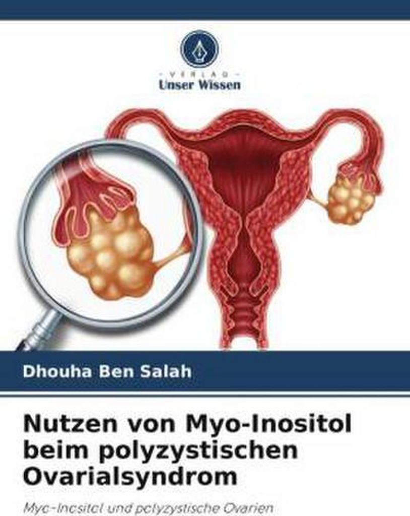 Nutzen von Myo-Inositol beim polyzystischen Ovarialsyndrom