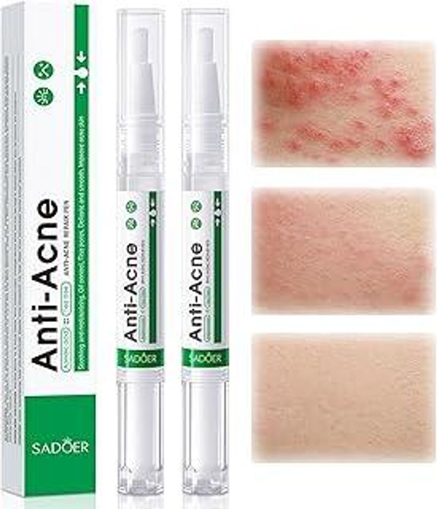 2xClear Pickelstift mit Teebaumöl - Anti Pickel Gel für frühe Akne,leicht einziehende Formel mit Präzisions for Skin Care
