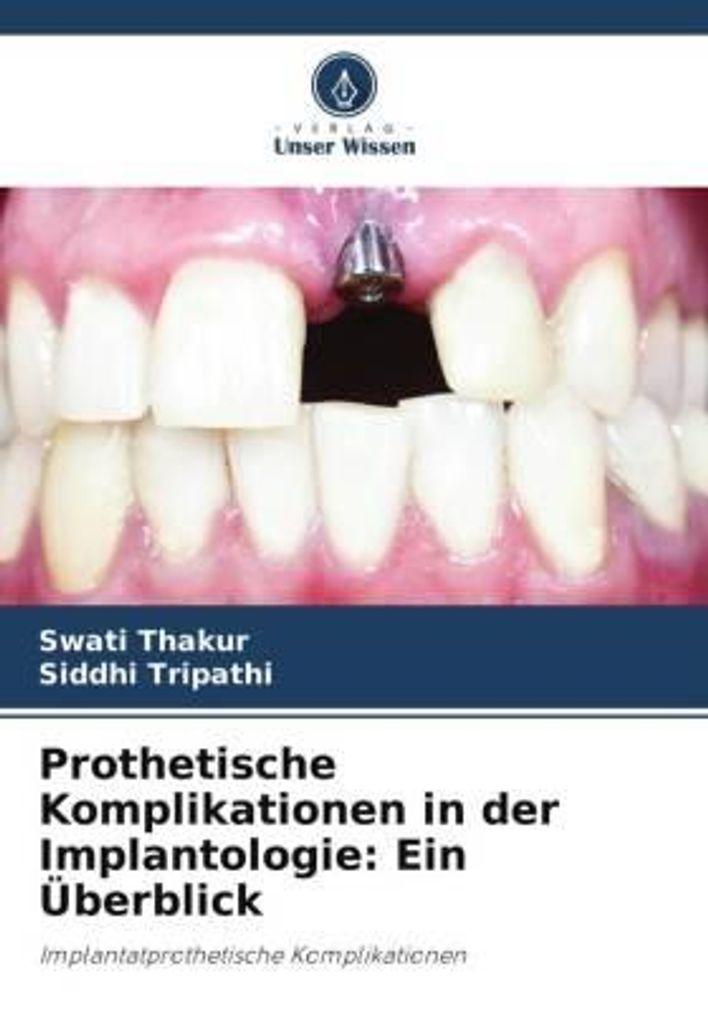 Prothetische Komplikationen in der Implantologie: Ein Überblick