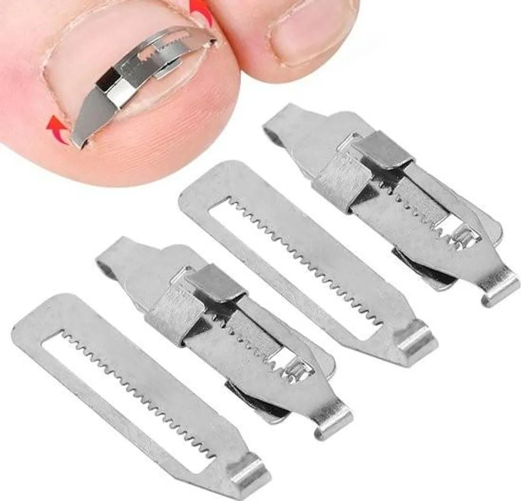 Appareil pour corriger un ongle incarné et apaiser le lit de l'ongle enflammé