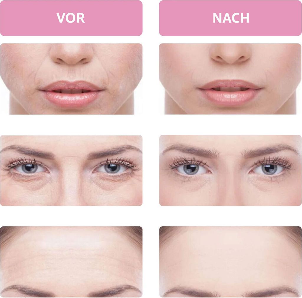 Kosmetisches Gerät Faltenentferner Gesichtsmassagegerät mit Produktbild 7