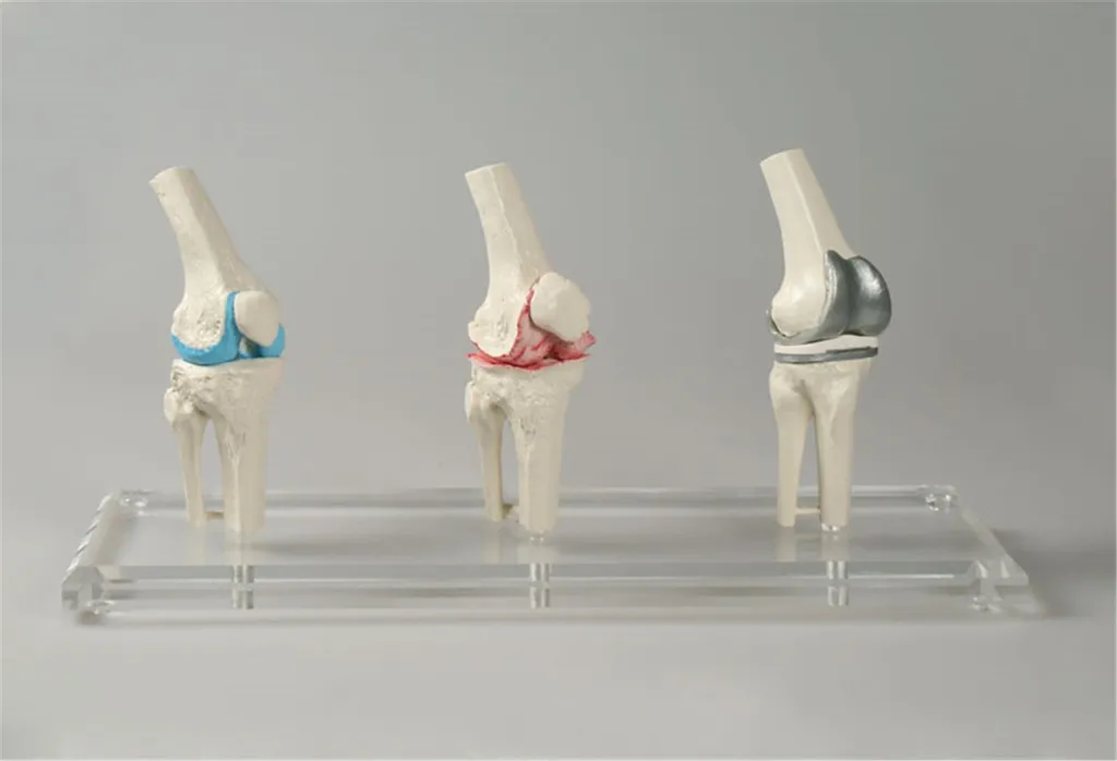 Modèle de genou Erler-Zimmer pour formation en chirurgie orthopédique