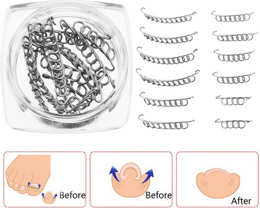 12 Stück Nagelkorrektur Draht für eingewachsene Zehennägel, Produktbild 