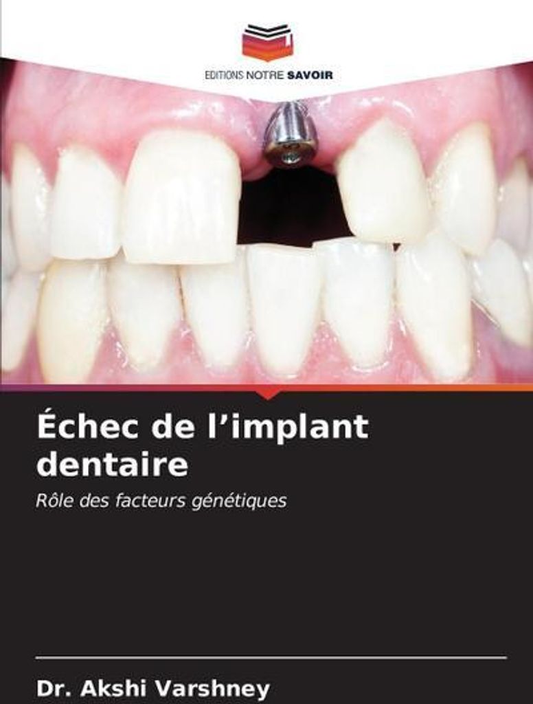 Échec de l'implant dentaire