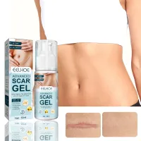 50ml Narben entfernen Gel, Narbensalbe Fortschrittliches Narbengel für Gesicht und Körper, Narbenpflege Behandlung Gel effektiv für Narben durch C-Sektion, Operationen, Verbrennungen, Keloid