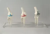 Knie-Implantat-Modell 3-teilig Anschaulisches Modell des Kniegelenkes