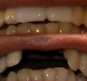 Quick Dental Tooth