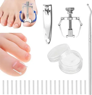 Produktbild von Ingangsstraps - pijnfrei - korrigierte Nagelkorrektur - 50 Stück - Behandlung - geeignet für - Ingangskorrekturen - Nagelkorrekturset