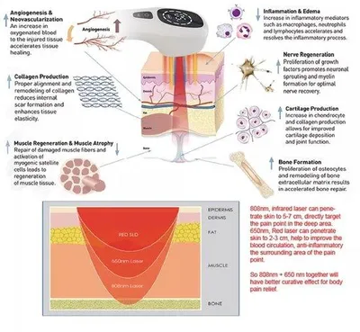 Obrázek produktu pro Laserový přístroj pro terapii svalů a kloubů – přenosný a elektronický – využívající infračervené a červené světlo
