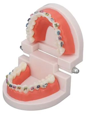 Orthodontisches Zahnmodell, Kunststoff, mit Zahnspange, Lehrmodell