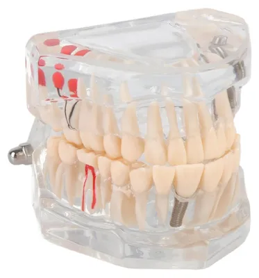 Produktbild von Zahnmodell Erwachsene - Transparentes Demonstrationsmodell - Zahnmedizinisches Modell - Orales Pathologisches Modell - 9x7x7cm - Kunststoff 232g