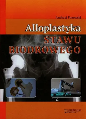 Imagen del producto de Aloplastia de la articulación de la cadera