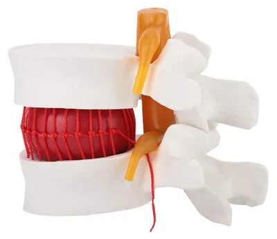 Anatomisches Lendenwirbelsäulenmodell 1:1,5 – Hernie-Modell für Medizinstudenten
