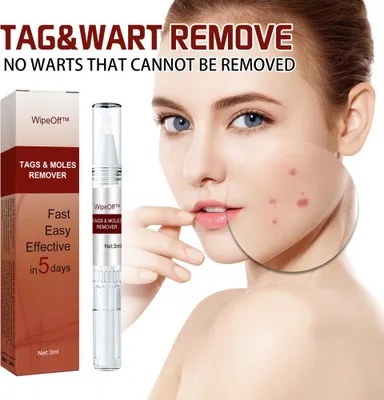 Produktbild von Hühneraugen- und Muttermal-Entferner für die Haut, Warzen- und dunkle Flecken-Reparaturlotion, bereichernde, wirksame Inhaltsstoffe, 3 ml