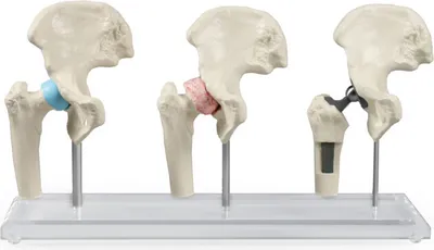 Immagine prodotto di Modello anatomico dell'anca in 3 fasi: sano, malato, con protesi, con supporto