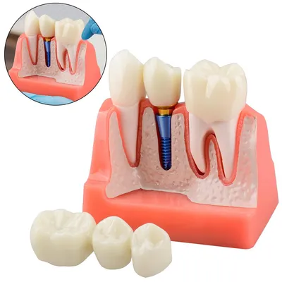 Produktbild von Ultraschall-Dentalmodell, 4-teilige Zähne mit Brücke – Lehr- und Demonstrationsmodell