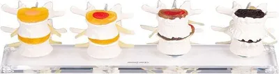 Obrázek produktu pro Anatomický model Erler Zimmer "Stupně poškození meziobratlové ploténky"