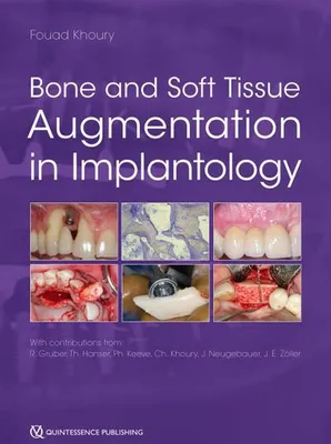 Obrázek produktu pro Bone and Soft Tissue Augmentation in Implantology