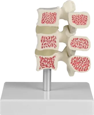 Obrázek produktu pro Erler-Zimmerův model osteoporózy 3 obratle