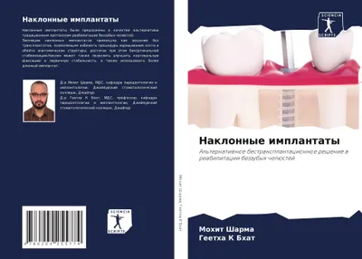 Produktbild von Naklonnye implantaty
