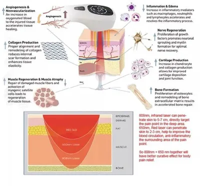 Image de Appareil de laserthérapie avec 4 diodes infrarouges de 808 nm – Pour soulager la douleur musculaire et articulaire