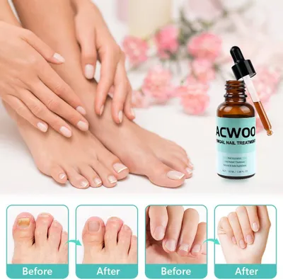 Produktbild von 30ml Antifungal Nail Treatment - Reparieren und Vorbeugen von Pilzinfektionen der Nägel