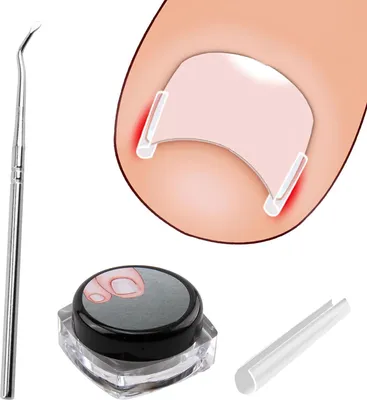 Produktbild von Set zur Korrektur von eingewachsenen Zehennägeln - 40 Stück schmerzfreie Glättungsstreifen und Zehennagelheber. Einfache Werkzeugset mit Schlagwörtern wie Pflege und Nagelpflege.