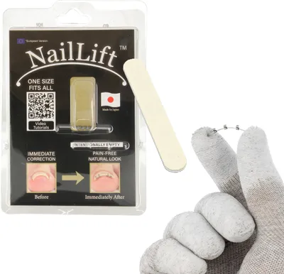 Produktbild von NailLift Nagelkorrektur Korrekturspange Für Eingewachsene Zehennägel | Brandneue Innovation | Von Mediziner Entwickelt | Sofortige Wirkung | Passend für alle Nagelgrößen |  Natürliche Passform