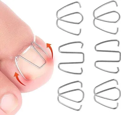 Image de Outil pour corriger les ongles incarnés