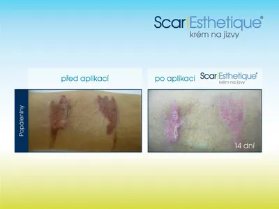 Produktbild von SCAR ESTHETIQUE Narbencreme 10 ml