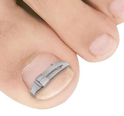 Produktbild von Nagelclip für eingewachsene Zehennägel
