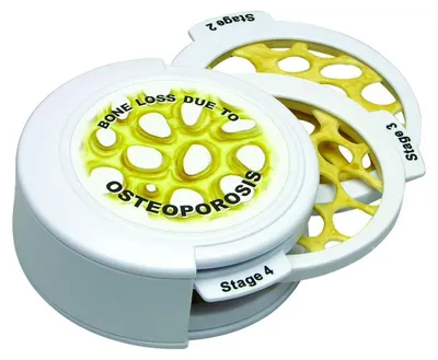Osteoporose-Modell, 4 Schichten, mit Lernkarte