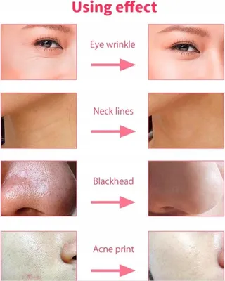 Produktbild von Diament-Mikrodermabrasion Gesichtsstraffung stark 100W