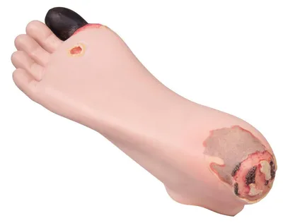Decubitus-Pflegesimulator Fuß – Diabetes-Folgeschäden, 1 Stück