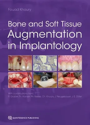 Obrázek produktu pro Bone and Soft Tissue Augmentation in Implantology