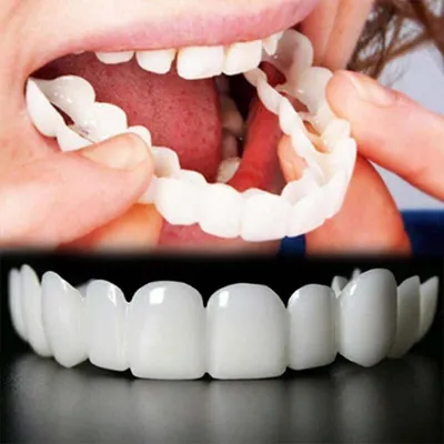 Image de Prothèses dentaires ajustables - Facettes dentaires naturelles pour adultes