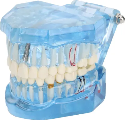 Immagine prodotto di Modello dentale denti mascellari impianti dentali