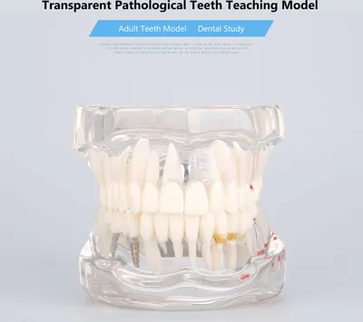 Image de Maladie dentaire Enseignement Étude Typodont Démonstration Dents Modèle Nouveau