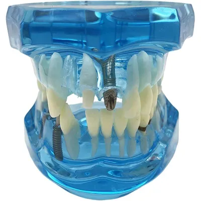 Zdjęcie produktu dla Verk 01964_N Model implantów dentystycznych niebieski
