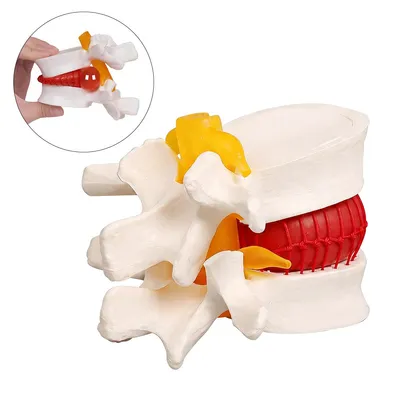 Produktbild von Lendenwirbelsäulen-Bandscheibenmodell 1,5-fach vergrößert, realistisches anatomisches PVC-Lehrmodell, für Unterricht, Diagnose und Patientenaufklärung