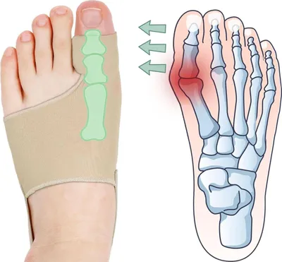 Produktbild von Ballenzehen Korrektor für Damen und Herren, Hallux Valgus Schiene zur Zehenkorrektur und Entlastung